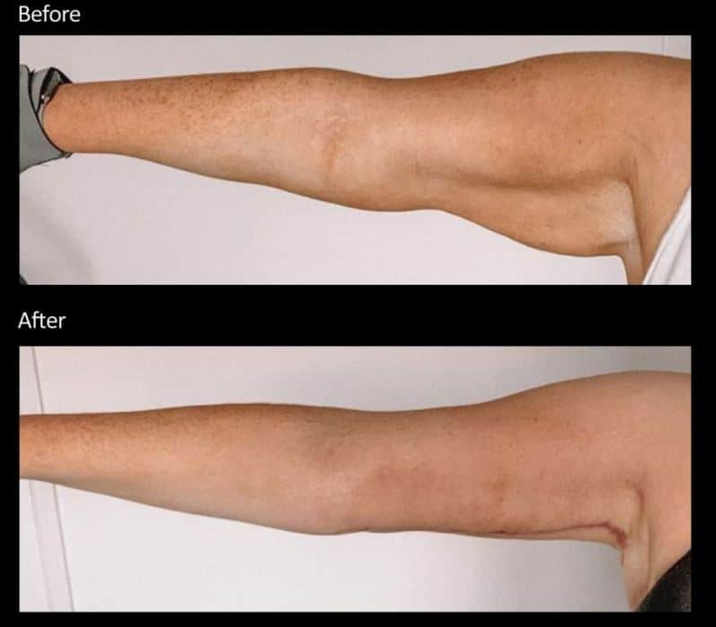 Arm Skin Tightening Before and After Arm Skin Tightening Before and After