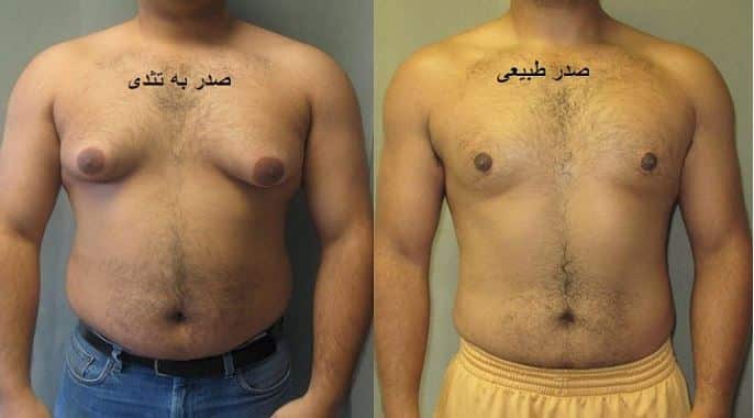 Treatment of gynecomastia in men