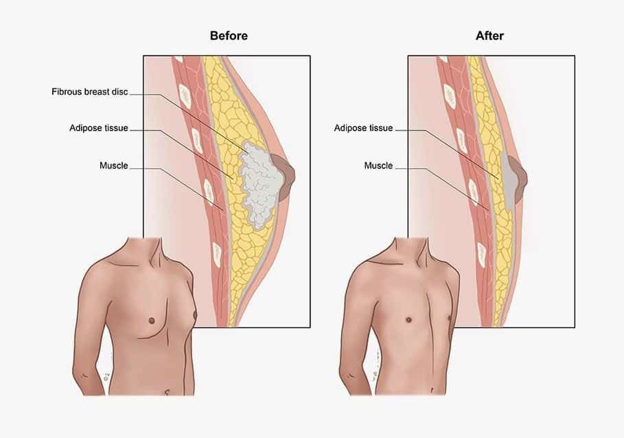 Treatment of gynecomastia in men