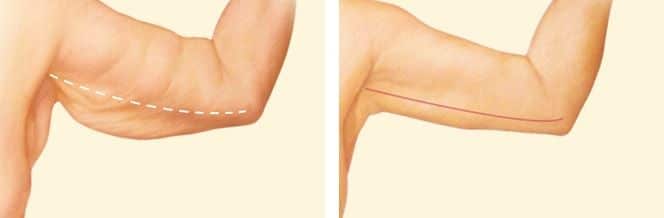 Why Arm Sagging Happens Why Arm Sagging Happens