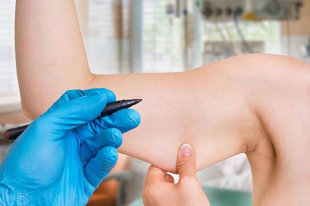Cost of Arm Lift Surgery in Egypt Cost of Arm Lift Surgery in Egypt