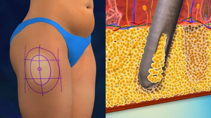 Vaser liposuction