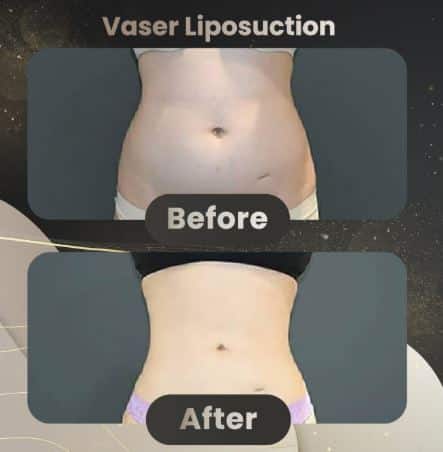 Vaser liposuction results