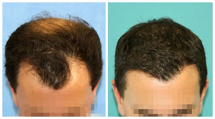 تؤثر زراعة الشعر على مظهر الشخص وجاذبيته وثقته بنفسه