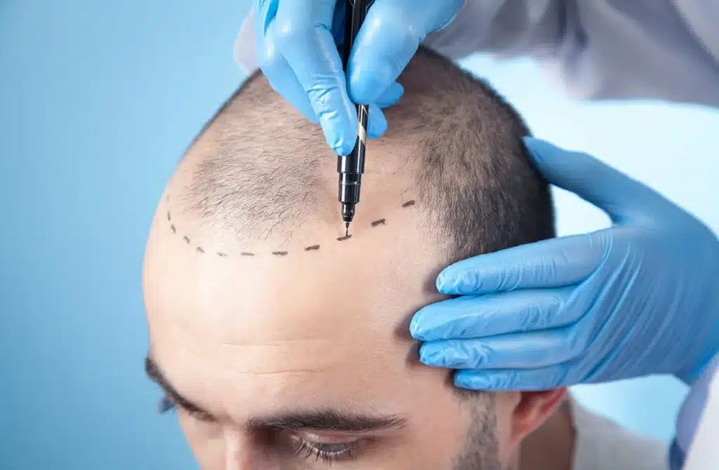 تبدأ زراعة الشعر بتحديد المنطقة المراد زراعتها أولًا