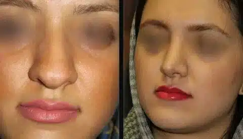 تجميل الأنف اللحمي قبل وبعد للحصول على أنف متناسق