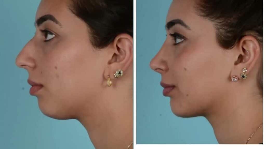 تجميل الأنف إجراء لتحسين شكل الأنف ووظيفتها