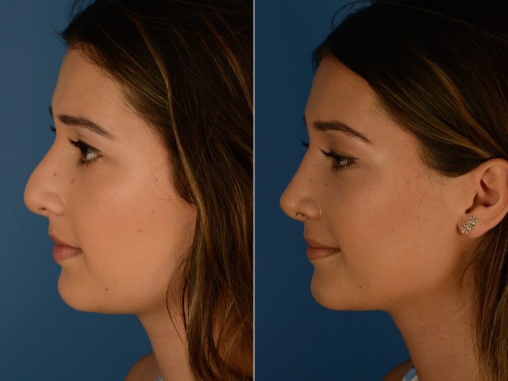 تجميل الأنف قبل وبعد 