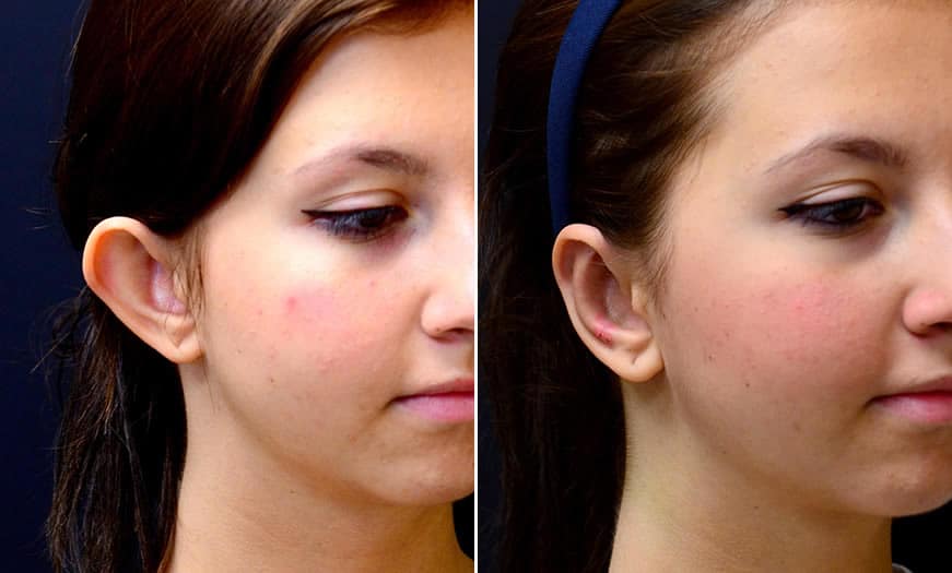 تجميل الأذن يُضفي جمالًا على ملامح الوجه
