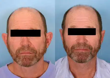 تغير شكل الأذن قبل وبعد عملية تجميل الأذن 