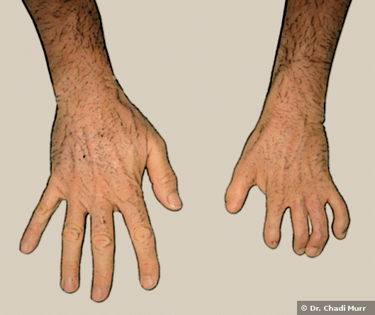 عمليات تجميل التشوهات باليد