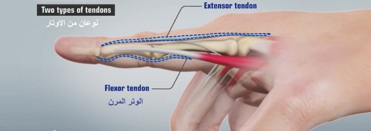 إصلاح اوتار اليد