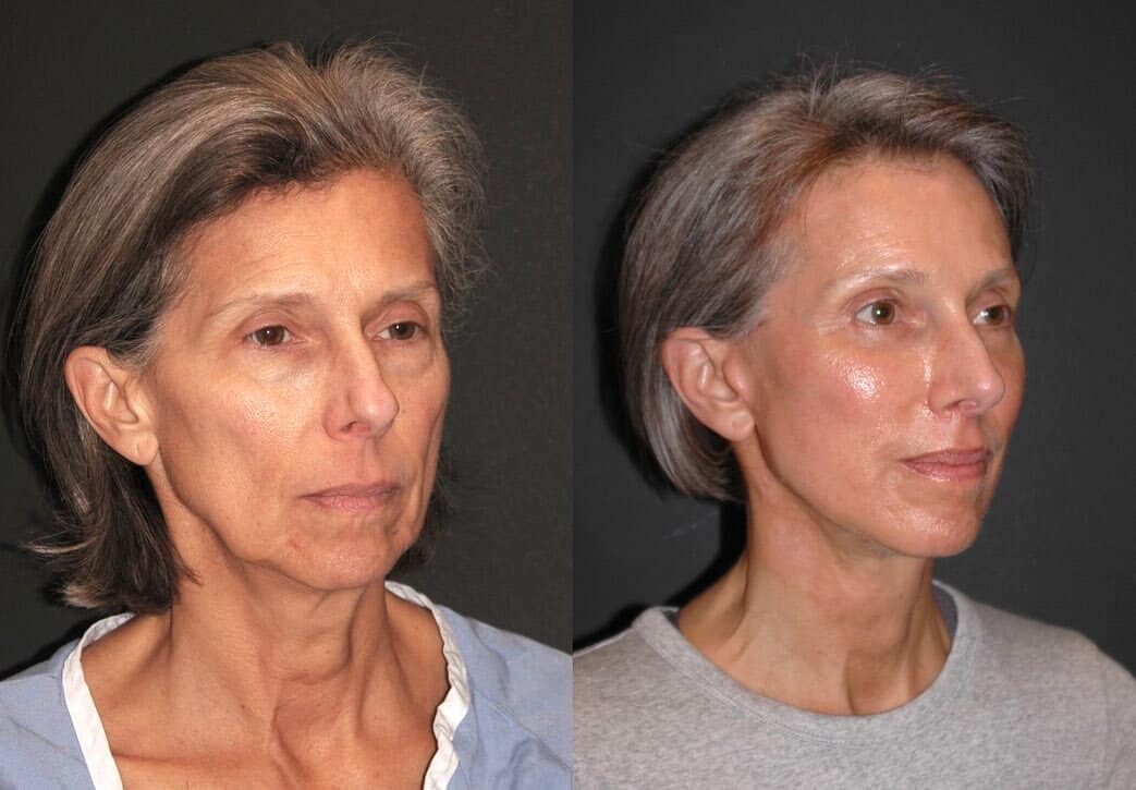 شد الوجه العميق بالمنظار Endoscopic deep facelift فرصة للحصول على ملامح جديدة شبابية 