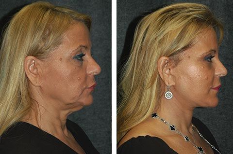 شد الوجه العميق بالمنظار Endoscopic deep facelift قبل وبعد