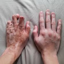 عمليات تجميل اليد