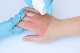 عمليات تجميل تشوهات حروق اليد