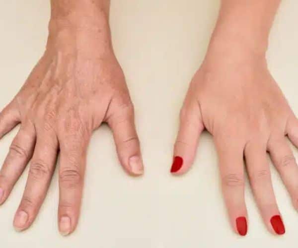 عمليات تجميل اليد