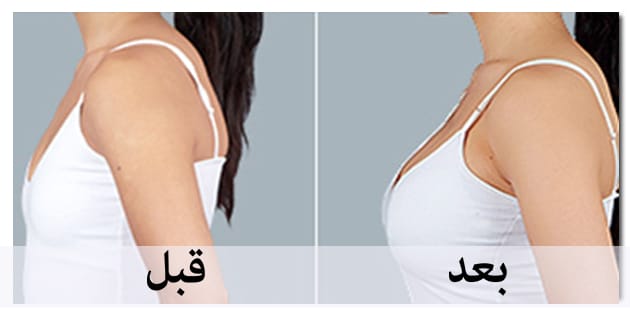  شد ورفع الثدي للمرأة