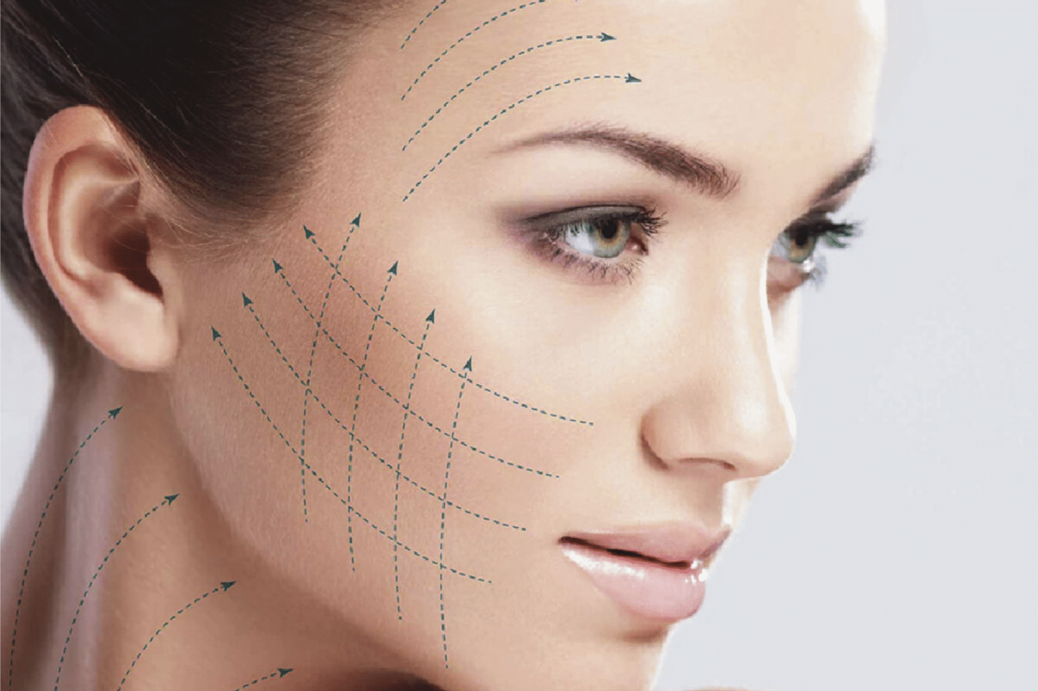 endoscopic deep facelift