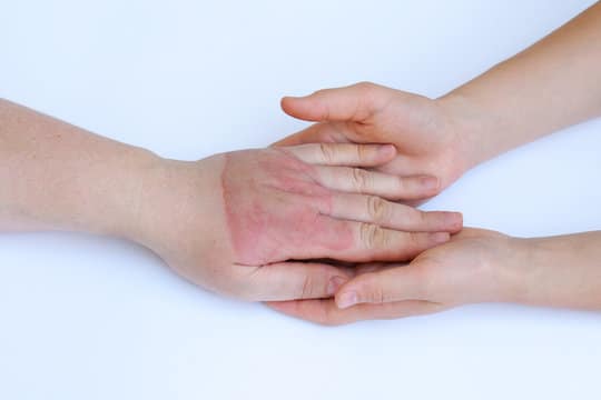 Burn Deformities