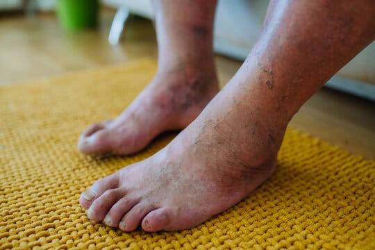 Restoration of Deformations in the Body