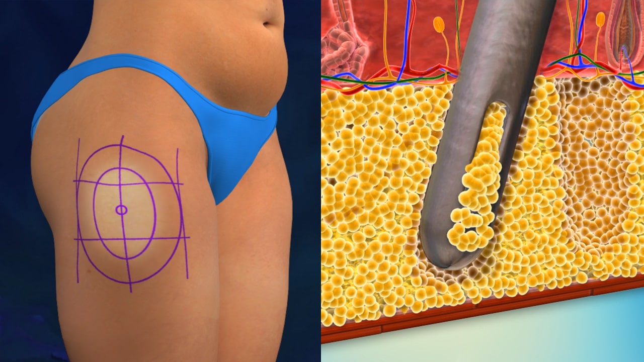 Liposuction