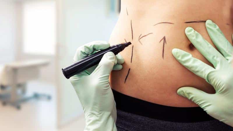  Liposuction