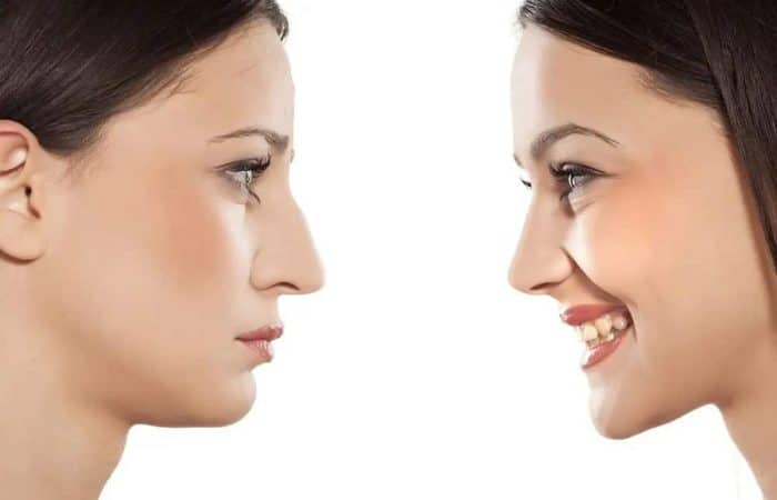  عملية تجميل الأنف