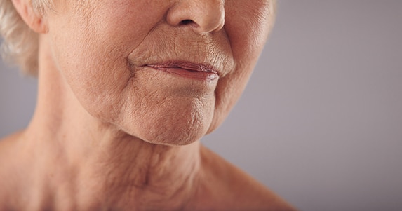 Face and Neck Lift