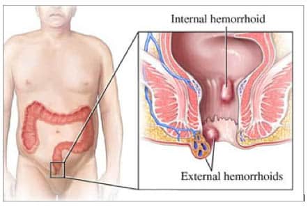 Laser Treatment for Hemorrhoids