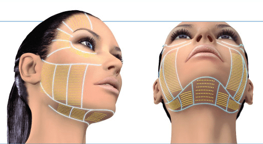 HIFU Facial Lifting