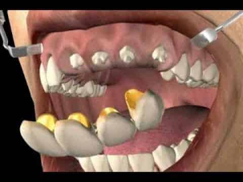 التركيبات الثابتة للأسنان
