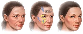 endoscopic deep facelift