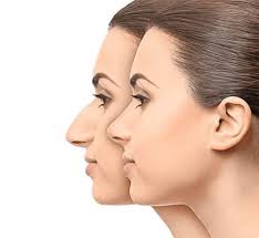  عملية تجميل الأنف