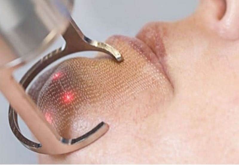 Fractional Laser