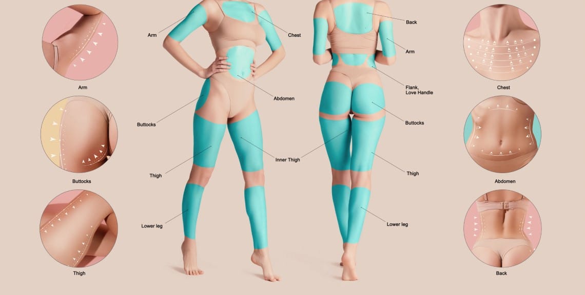  Liposuction
