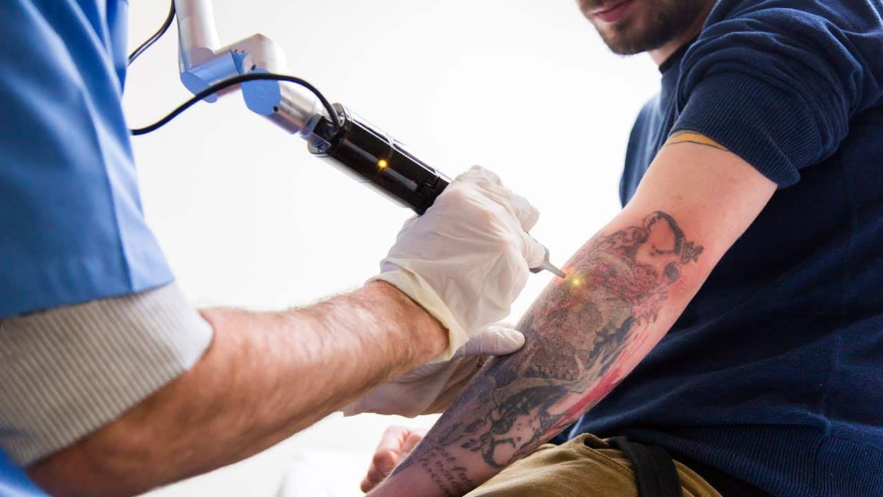 Laser Tattoo Removal