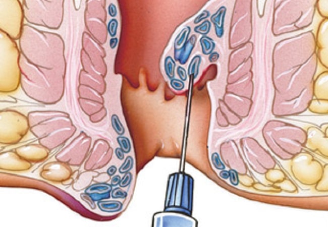 Laser Treatment for Hemorrhoids