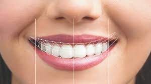 ابتسامة هوليوود للأسنان