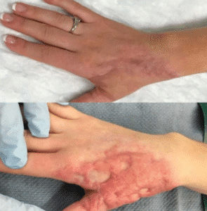 علاج آثار الحروق بالليزر